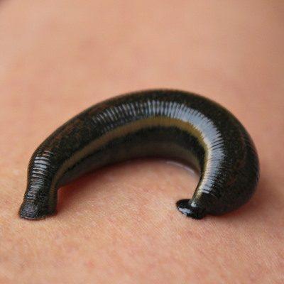 Leech Therapy in Dehradun