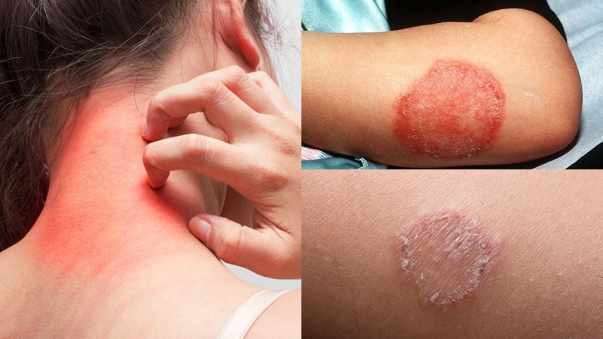 Herbal support for fungal and itching skin problems