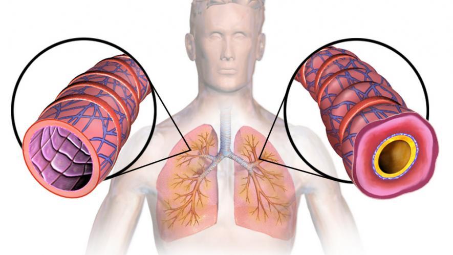 Damma Tuberculosis Herbal Treatment