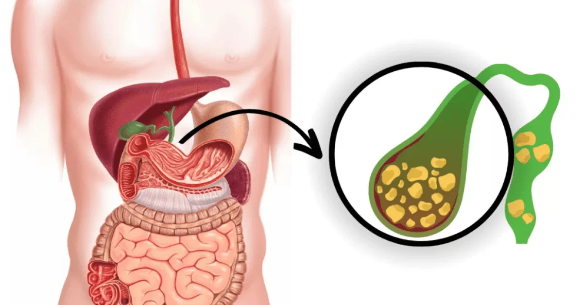 Herbal treatment concept for gallbladder and liver stones