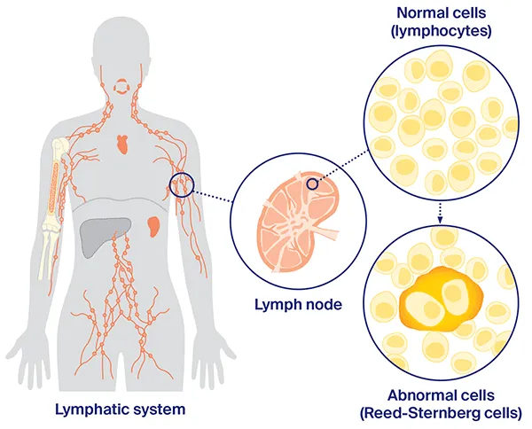 Lymphoma education poster