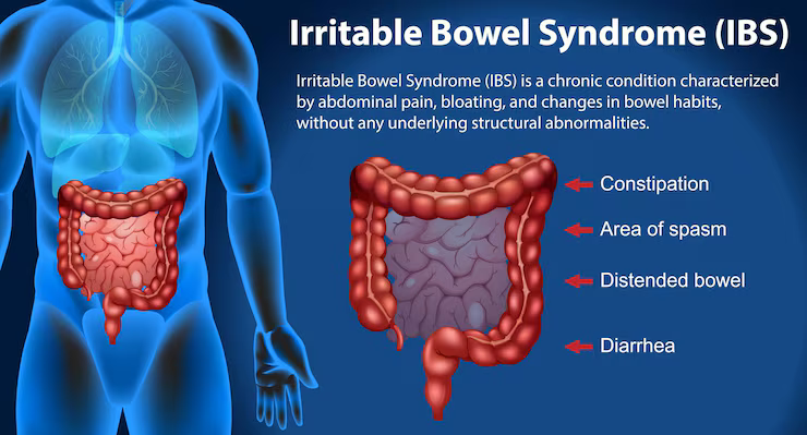 Patient discussing IBS symptoms with a doctor