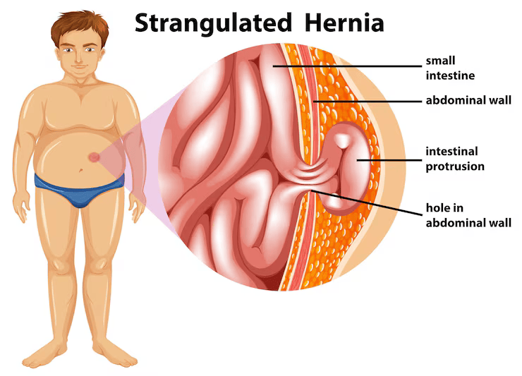 Herbal support for hernia and abdominal strength