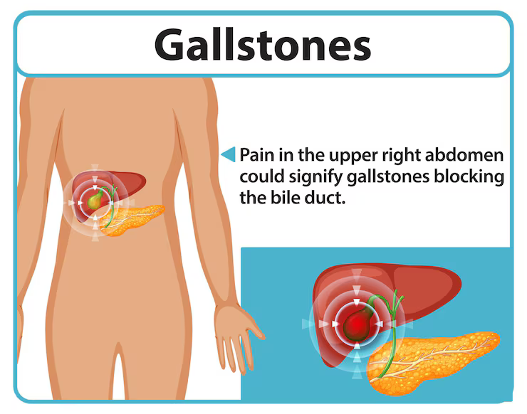 Woman experiencing Gall Bladder Stone pain
