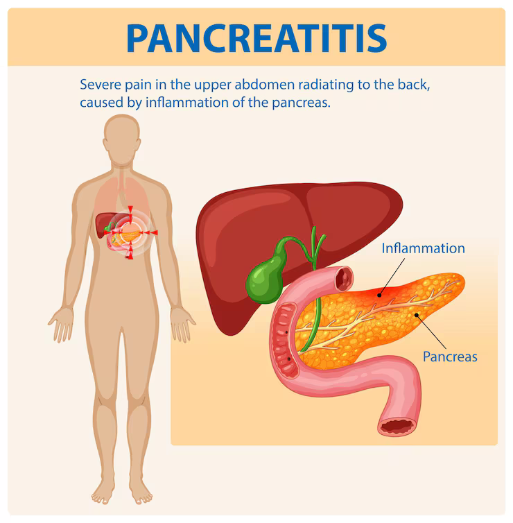 Diagram showing Chronic Pancreatitis